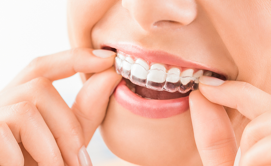 Invisalign, dentist dental office near me All smiles dental Vacaville CA